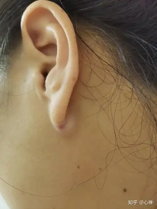 耳垂囊肿