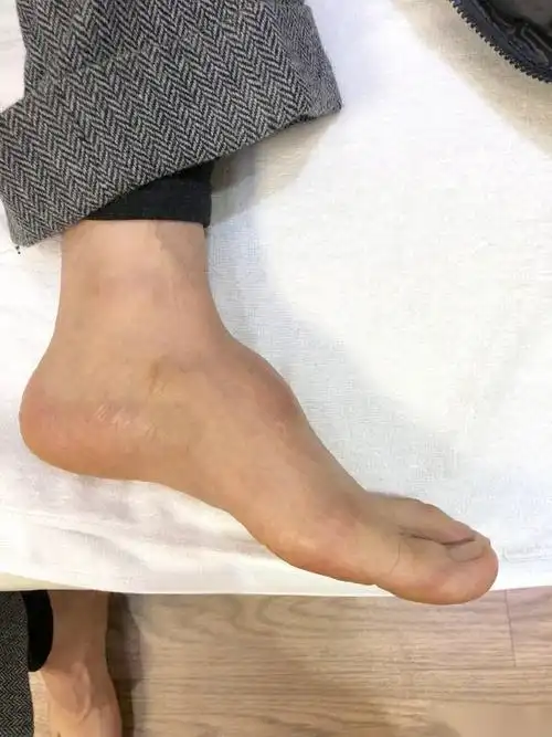 因为拍戏受伤,所以左脚一直比正常的脚面高出很多,明明是脚上打了钢钉