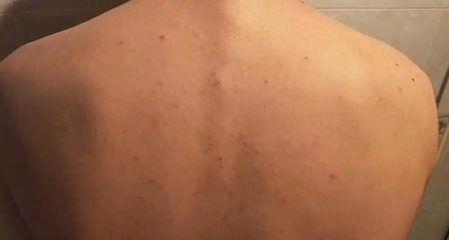 长沙皮肤病医院解答_医生_毛囊_药物