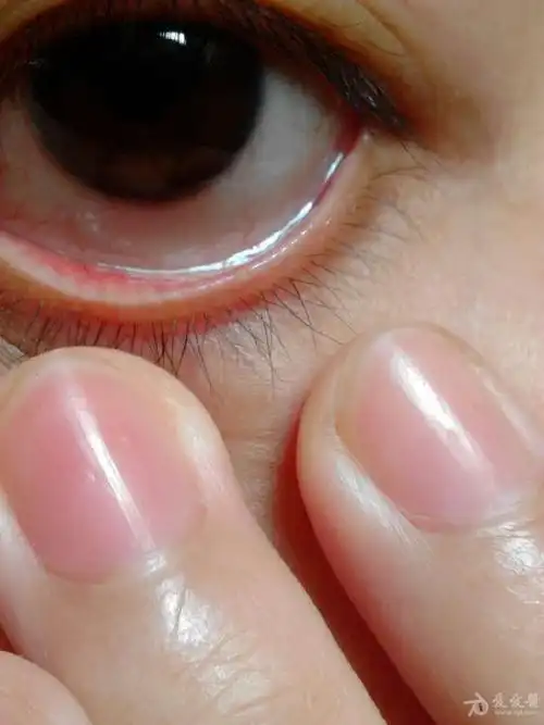 请各位帮我看看下眼睑起的小泡什么