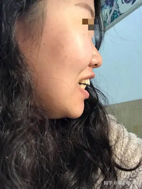 矫正完后牙齿侧面看龅牙而且嘴秃了我家人都这么说不知道这算不算拔牙