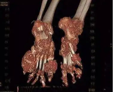 降尿酸药能溶解尿酸盐结晶痛风石吗