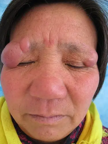 【病例讨论】老年女性面部多发结节一例,病理已做,未