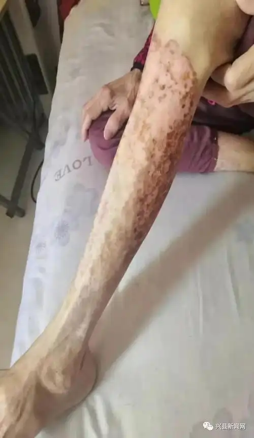 兴县:皮肤科引进新技术 一例难治巨大皮肤溃疡患者治愈出院