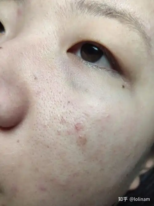 毛孔粗有黑头怎么办,脸上的毛孔粗大有黑头怎么办