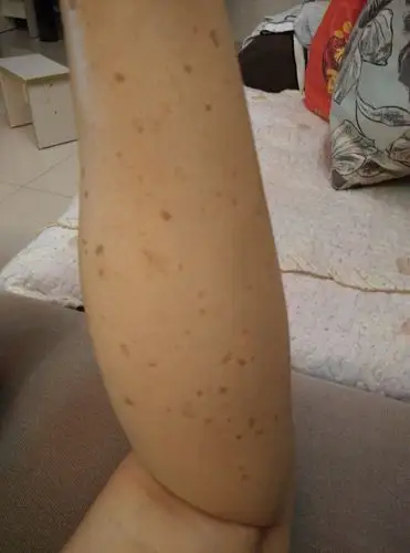 腿上长这些斑点是什么原因,女