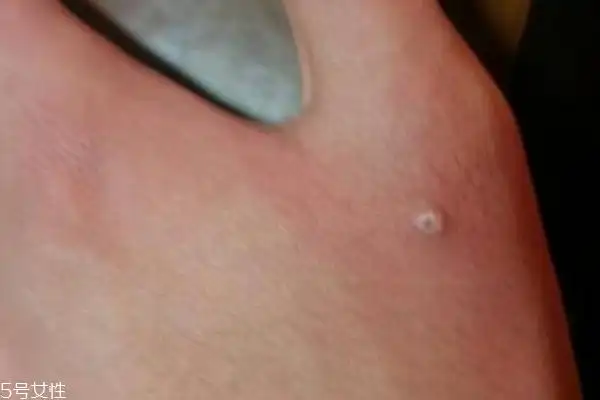 手上长了个硬疙瘩怎么回事手上长了个硬疙瘩像茧