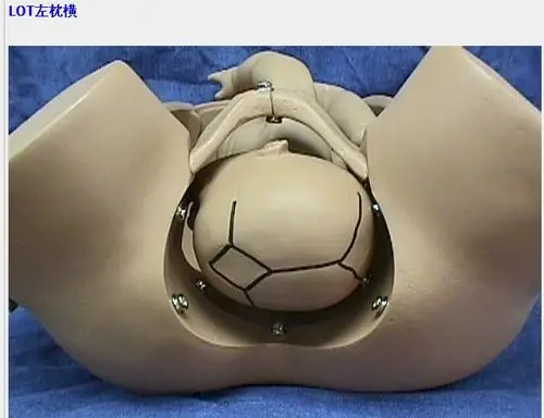 怀孕32周 3照彩超胎头位于lot是否胎位不正