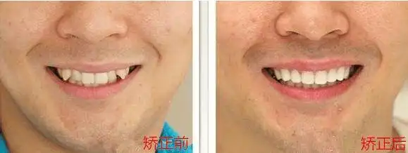 虎牙是怎么形成的到底该不该拔牙拔了之后牙齿会变好看吗