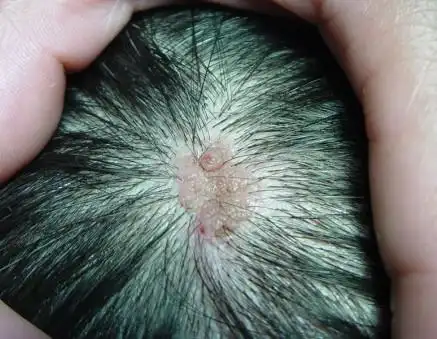 脸上有好多黑痣,闺密说美容院化学药水点痣挺好的,有啥危害吗?