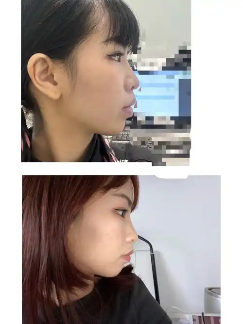 嘴凸戴牙套一年半矫正正畸前后对比