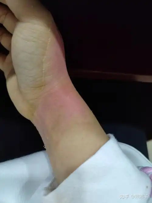 记录一下被烫伤的恢复过程