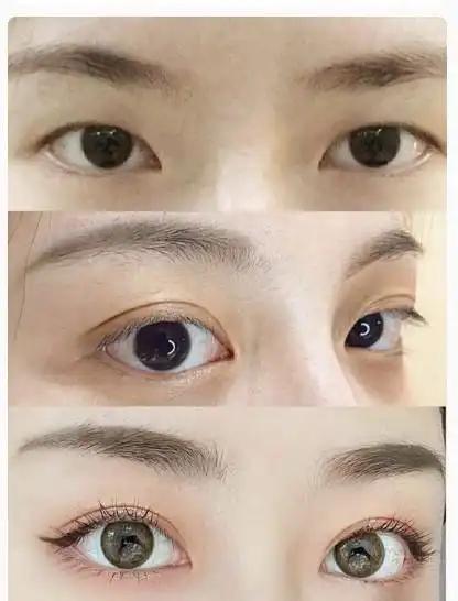 单眼皮变双眼皮的图片_整形达人问答