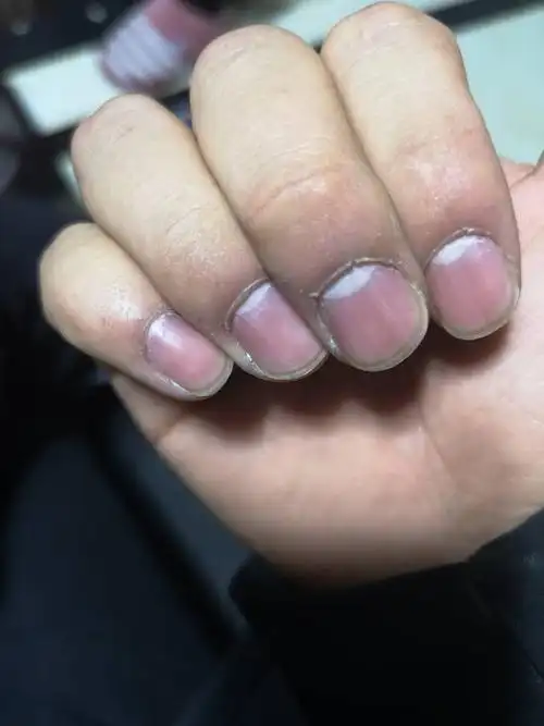 手指甲这样正常吗?