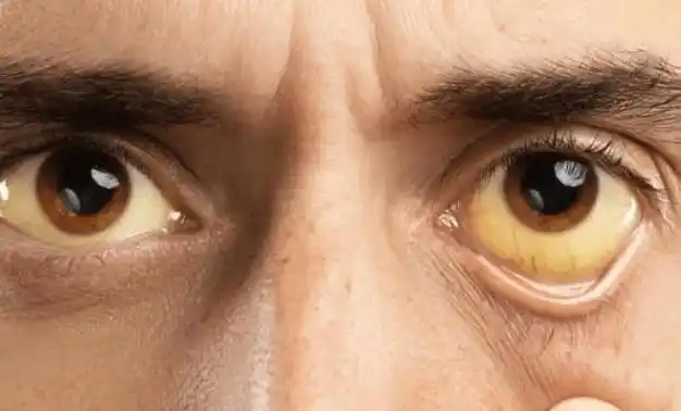 二,眼黄皮肤蜘蛛痣是因为肝内的雌激素作用降低,导致毛细血管扩张,多