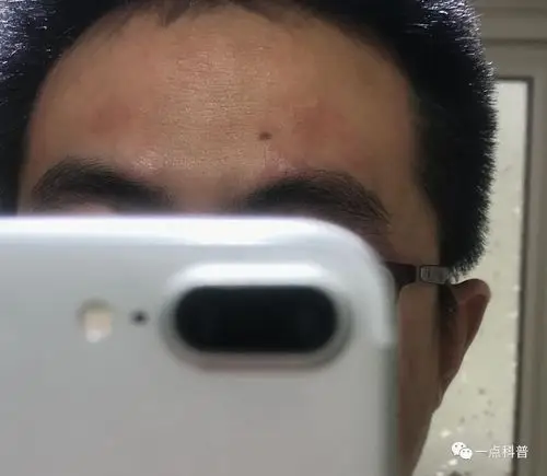 我脸上的湿疹,终于治愈了!