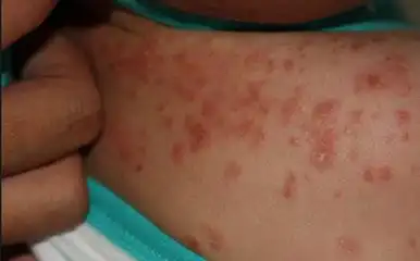 疥疮有什么伴随症状呢?