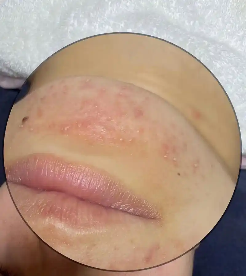 如果你的脸油光满面 就是温度上升.油脂分泌旺盛 堵塞毛孔   - 抖音