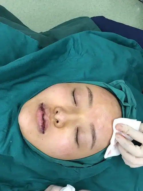 做完嘴巴第七天,今天去医院拆线,图一是术后即刻,_圈子-新氧美容整形