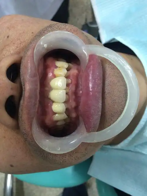 种植牙效果图 - 好大夫在线