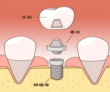 口里有种植牙,还能做核磁共振吗? - 健康科普 - 新湖南