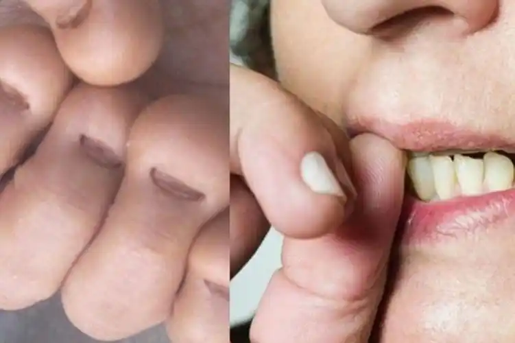 指甲到底有多少细菌显微镜下放大200倍观察看完还敢啃吗