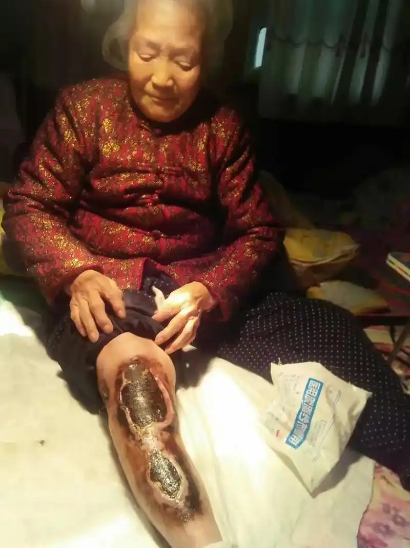 闻喜县桐城镇王顺坡村七十六岁老人,无意烧伤,皮肤坏死,深度露 - 抖音