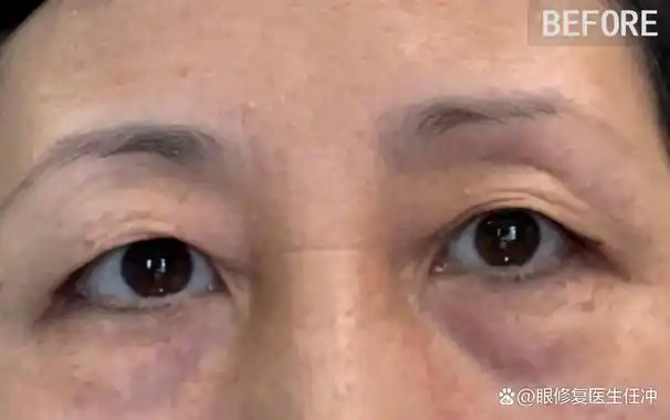 眼皮太松弛怎么办 眼皮太松弛怎么办图片