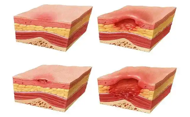 引起持续缺血,缺氧,营养不良而引起的组织溃烂,坏死皮肤压疮是康复