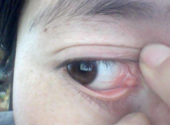 眼角长了个疙瘩图片 (42)