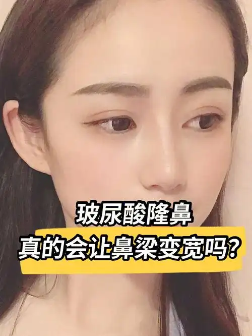 玻尿酸隆鼻会让鼻梁变宽吗7173