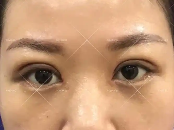 4年前做的埋线双眼皮,没多久松脱了,形成多皱褶.
