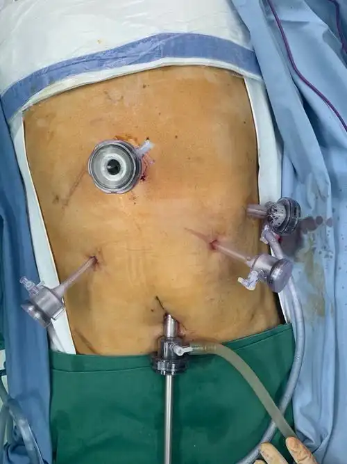 食管癌案例分享:新辅助化疗 微创mckeown手术 - 好大夫在线