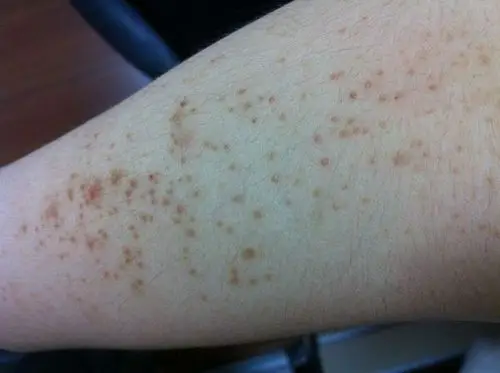 一开始以为是毛孔堵塞,夏天多出汗就行,结果出再多汗还是不消,请问有