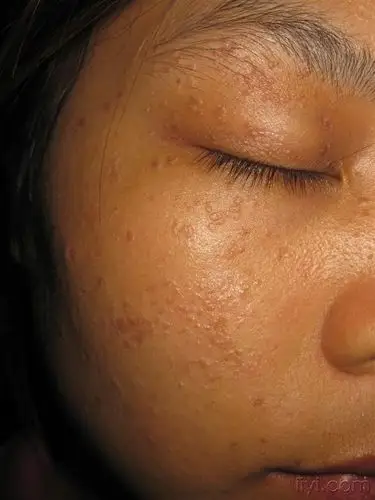 面部泛发扁平小丘疹2年,无痛痒.