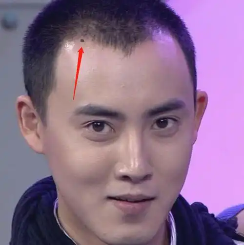 女人发际线边缘有痣代表什么发际边缘有痣