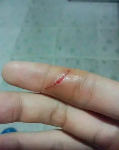 伤口流血家庭应急处理