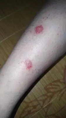 我是系统性红斑狼疮患者,六年了,每年夏天腿上经常出现带泡的红斑