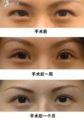 双眼皮前后对比