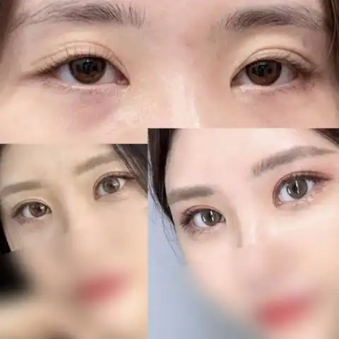 韩国双眼皮修复病例对比图合集,快种草韩国好的眼修复医院-非常爱美