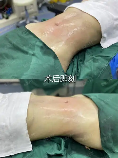 腰腹吸脂术后第1天