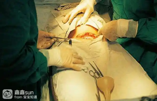 图解剖腹产手术全过程,胆小者勿入