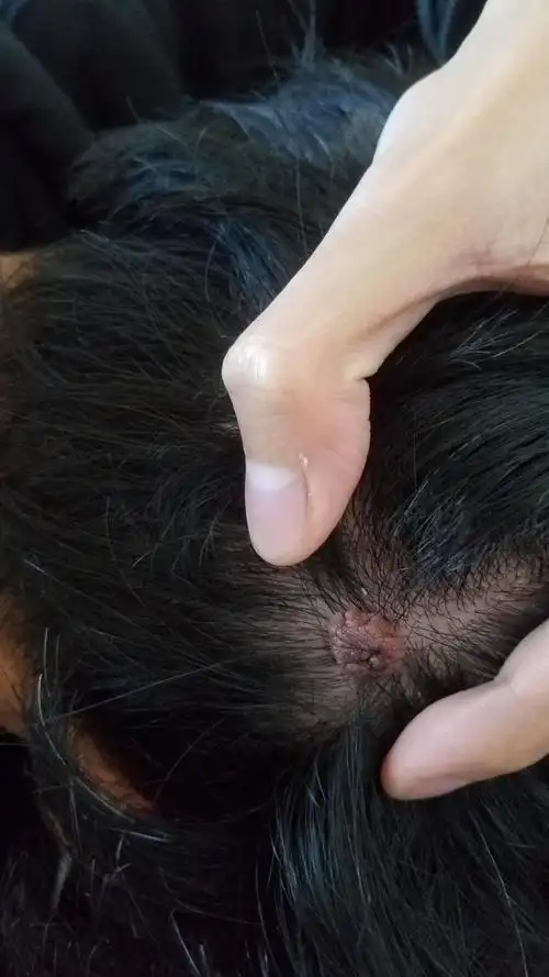 后脑勺长了肉粒,去医院可以割掉吗