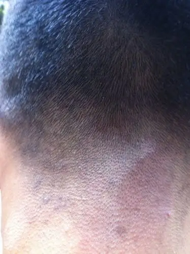 女生的头癣初期图片_有来医生