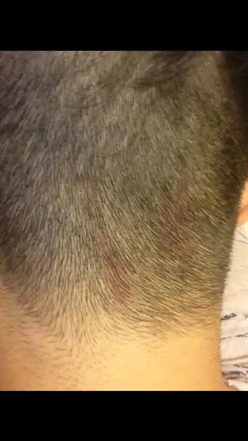 您好最近两周发现头上有这种红斑请问是什么情况?谢谢