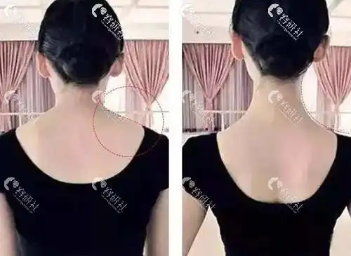 (瘦肩针注射前后对比图)斜方肌与个人习惯有很大关系,包括含胸驼背