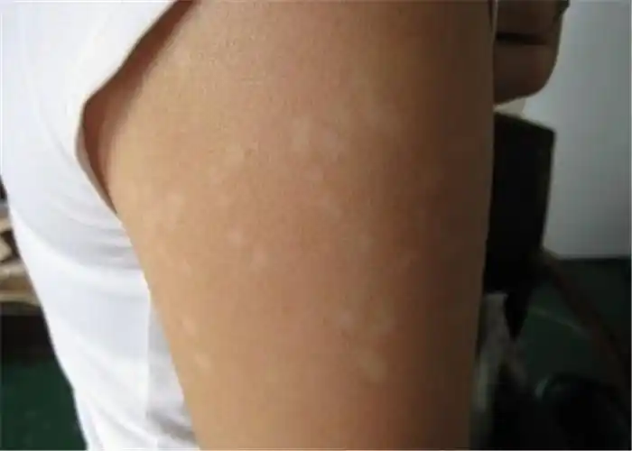 花斑癣头部脱毛症状图片