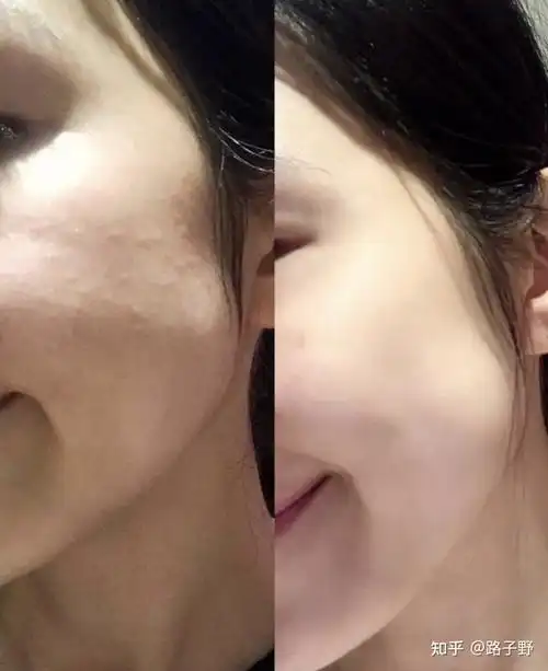 常年熬夜脸还有机会变白吗