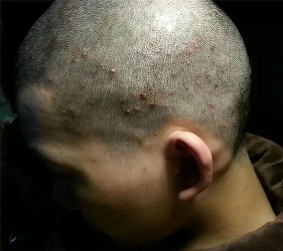 男童头皮毛囊炎康复图片_有来医生