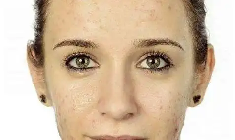 皮肤出油怎么办